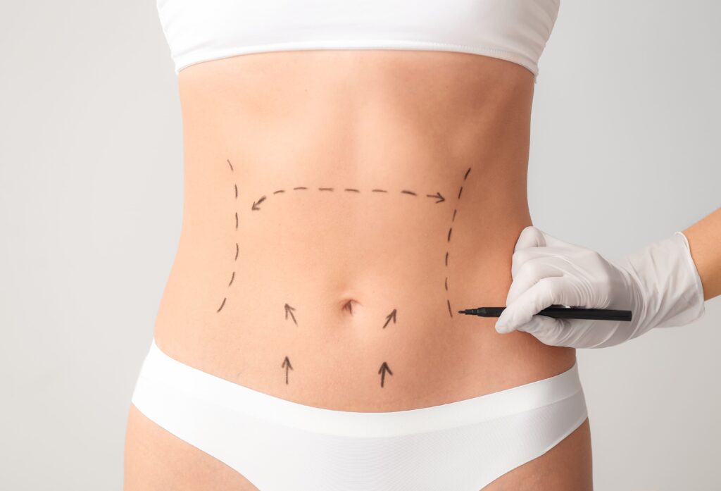 abdominoplastia-1