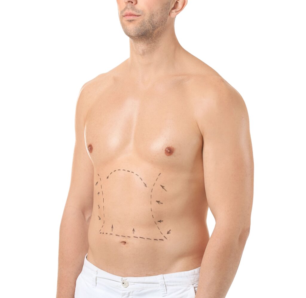 abdominoplastia-hombre-2