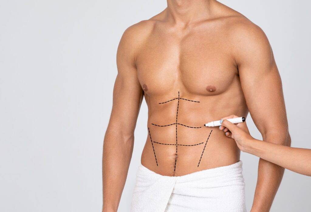 liposuccion-abdomen-hombre-1