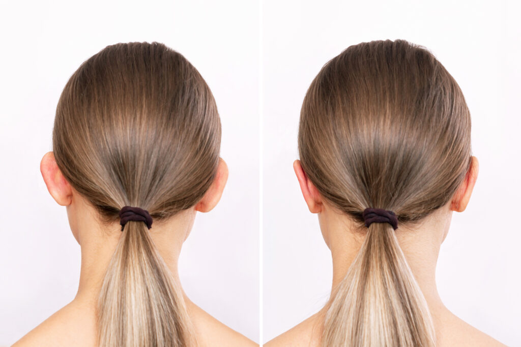 Rear view of a woman's head with ears before and after otoplasty isolated on a white background. Result of cosmetic plastic surgery to correct the auricles and get rid of lop - eared. Beauty concept